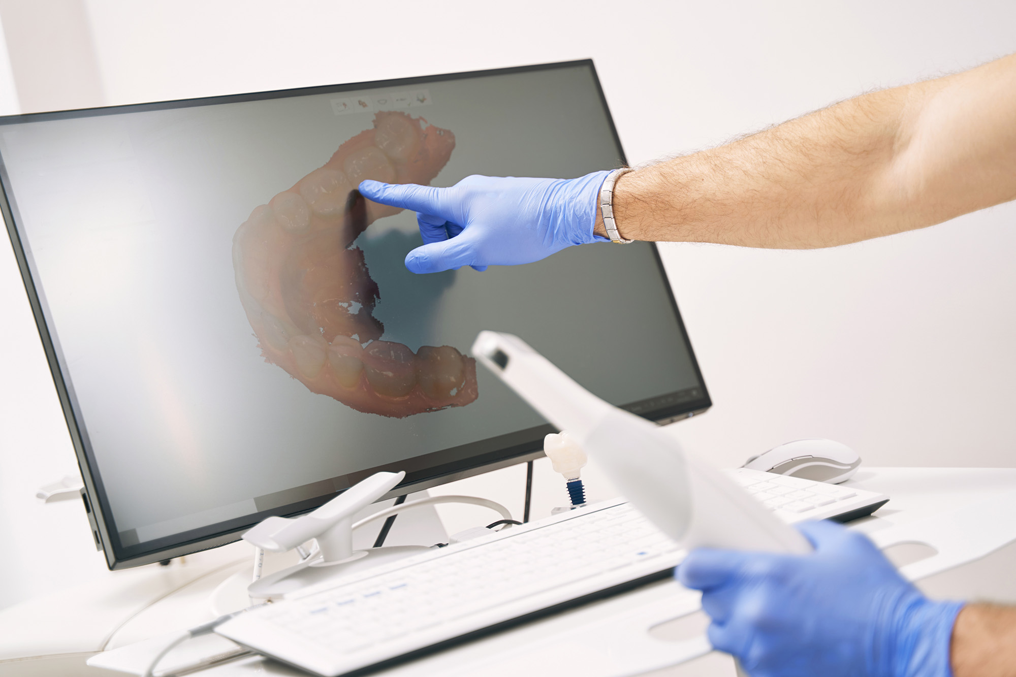 Intraoral 3D scanning